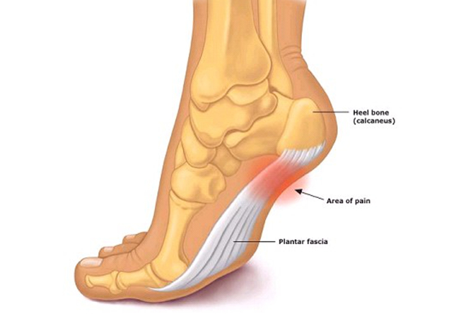 Plantar-Fasciitis---Dorval-Physiotherapy-in-Oakville